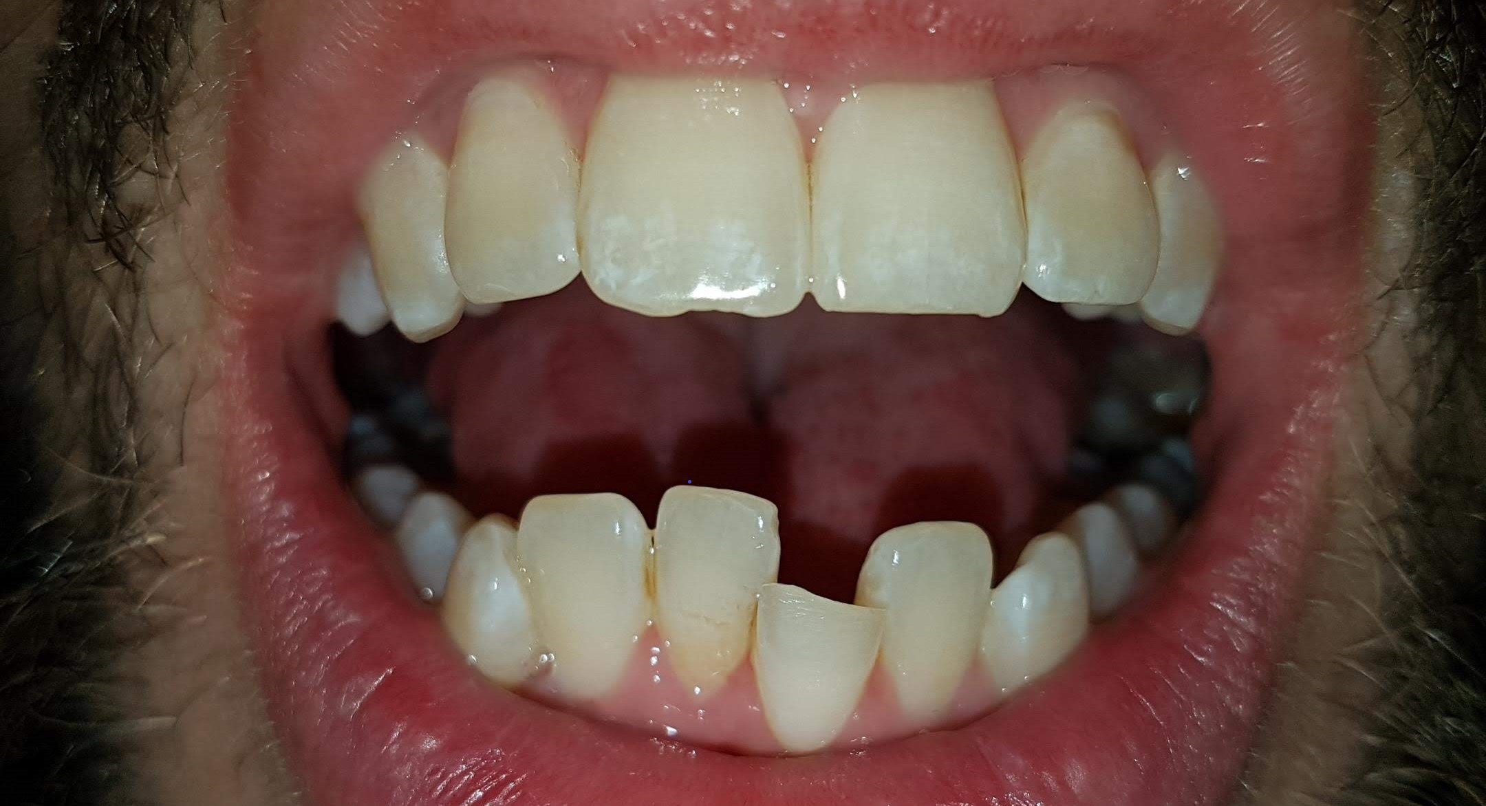 Invisalign Bristol before case 1 crowded teeth