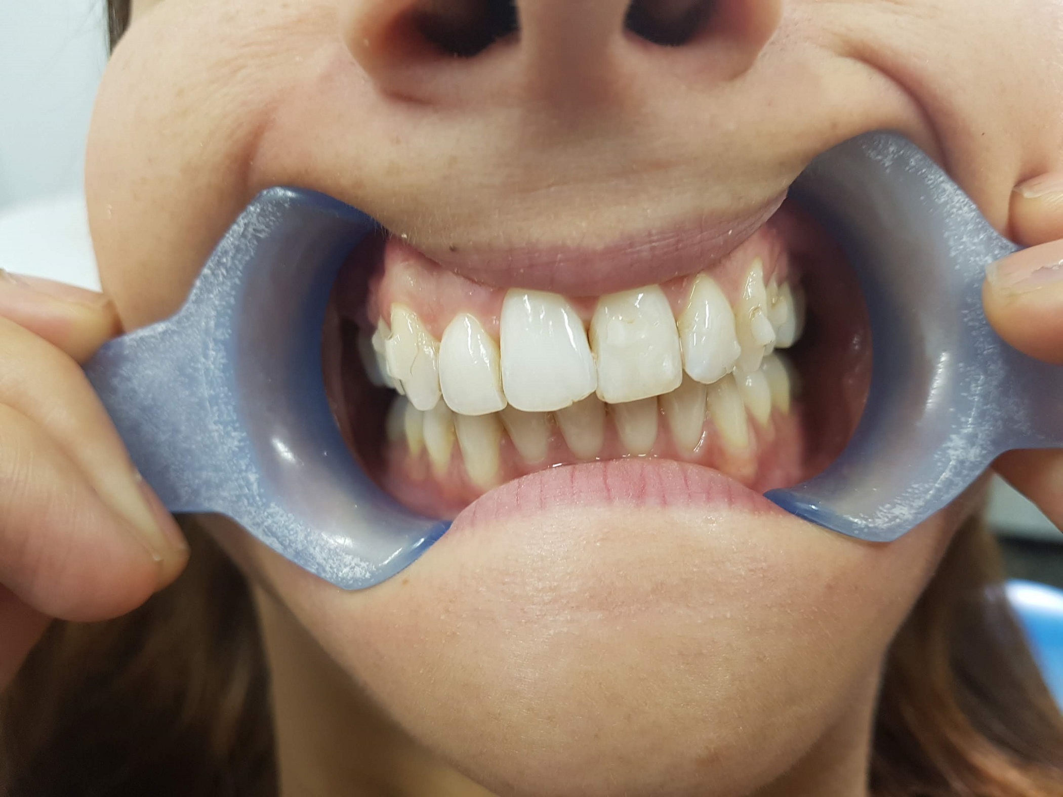 Invisalign Bristol after case 2 closed gaps