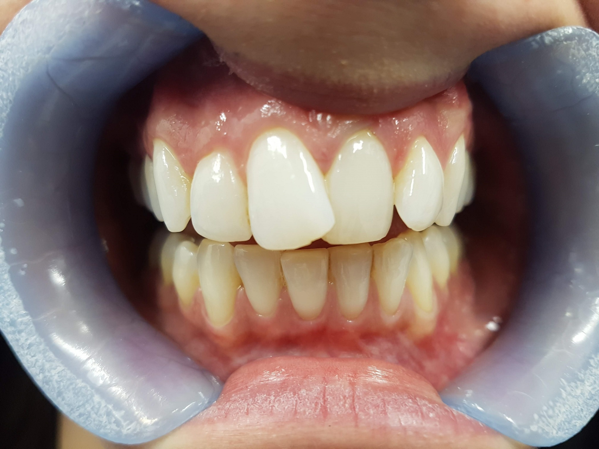 Invisalign Bristol before case 2 spacing