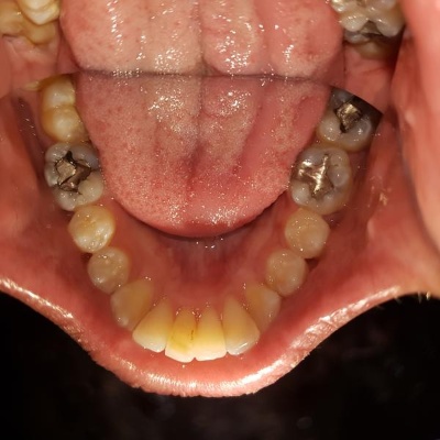 Invisalign Bristol after case 3 improved bite