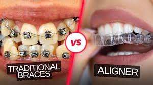 Close up of Invisalign clear aligner on teeth